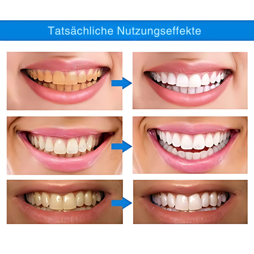 1+1 Free | OpalSmile™ – Achieve Bright White Teeth Quickly