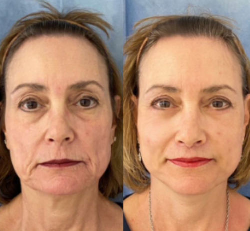 1+1 Free|NatuGlow™ – The Perfect Solution for Immediately Smoother, Radiant Skin