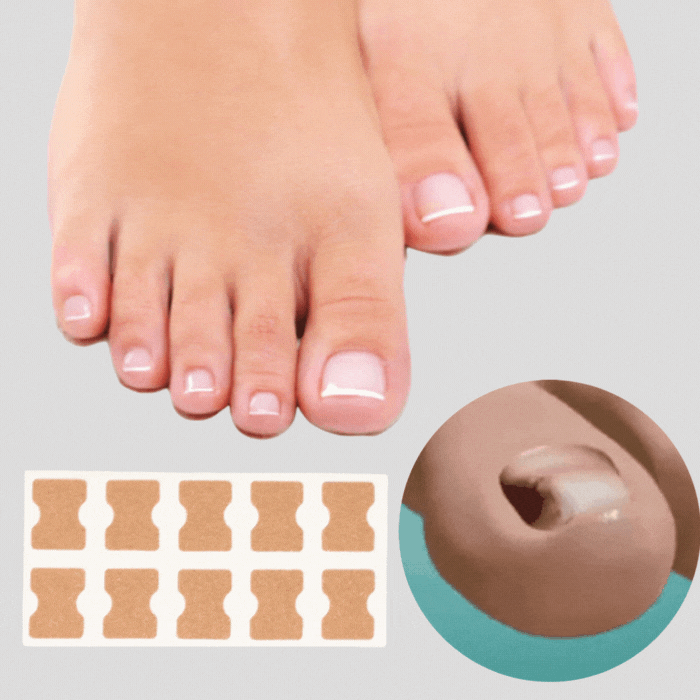 (50% Discount) FinePatches™ | Nail Correction Patches for Healthy and Beautiful Nails