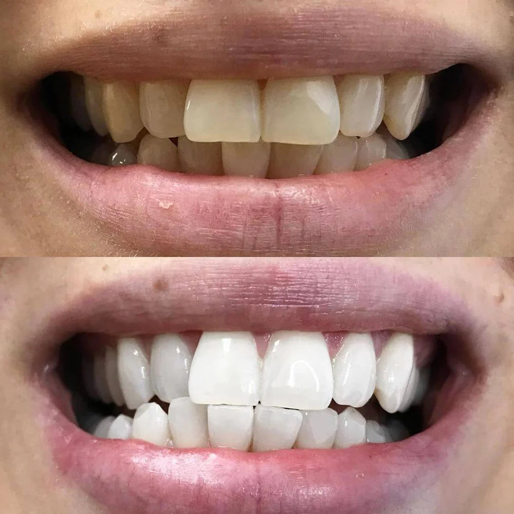 LumaShine™ — Unleash a Brilliant Smile That Commands Every Room