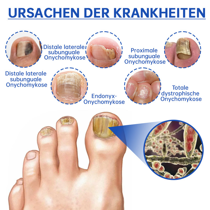 PureNail™ — Zap Nail Fungus Painlessly & Fast | 50% Off