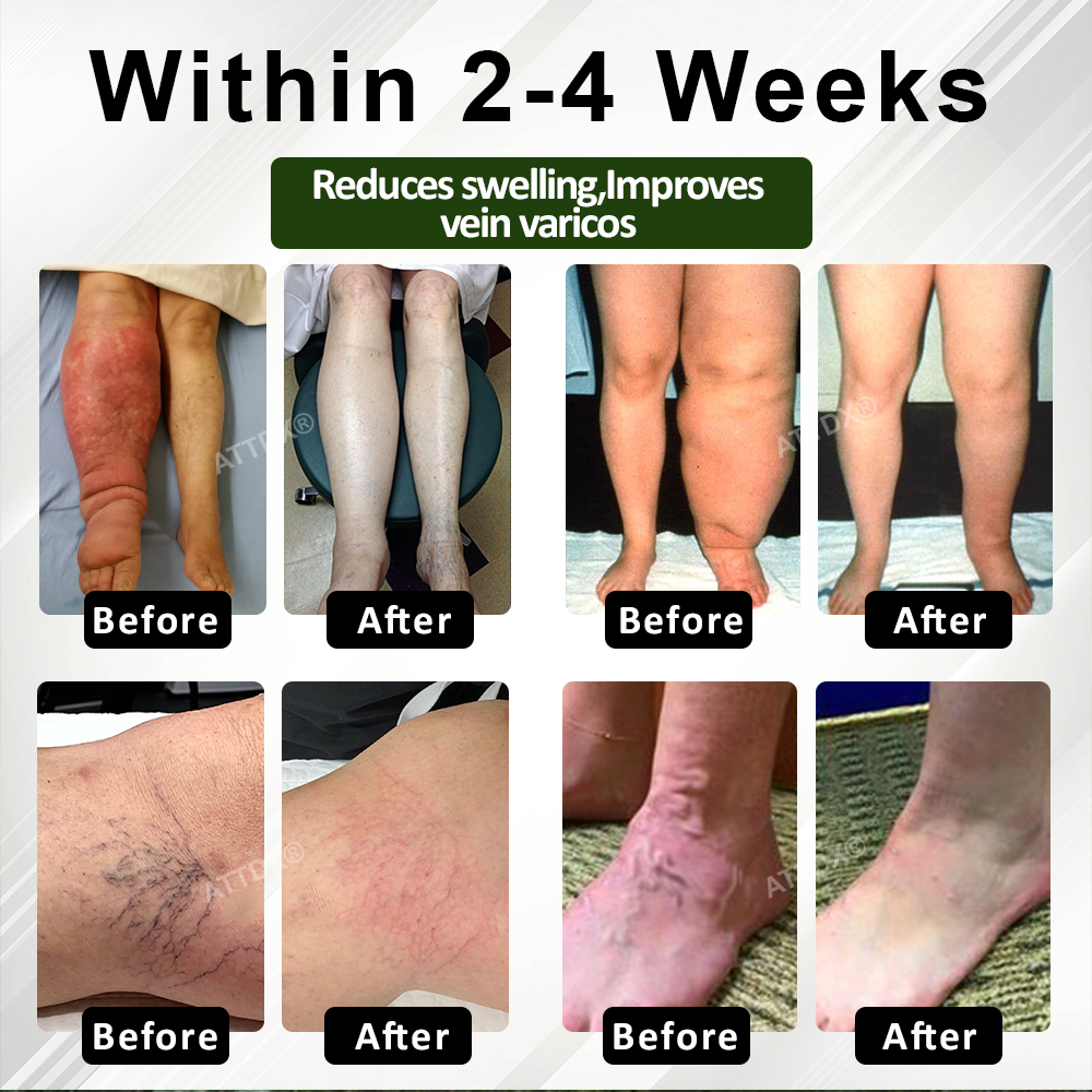 VascuRelief™ — Banish Swelling and Rediscover Effortless Freedom