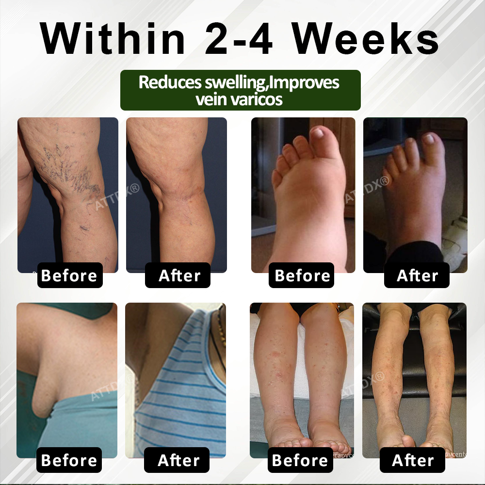 VascuRelief™ — Banish Swelling and Rediscover Effortless Freedom