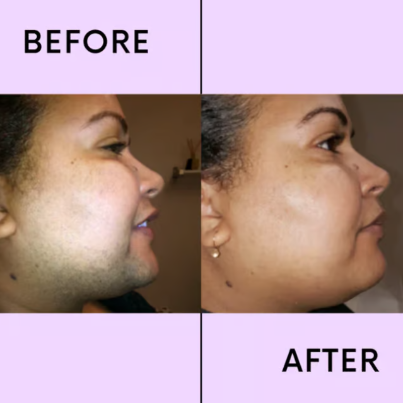 SilkaNova™ — Melt Away Hair Pain-Free for Skin That Glows All Day