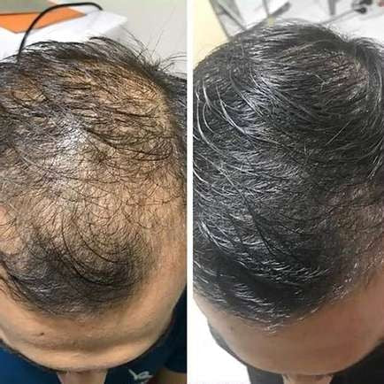 1+1 FREE | RiceGlow™ - Hair Loss Prevention (Final Day Discount)