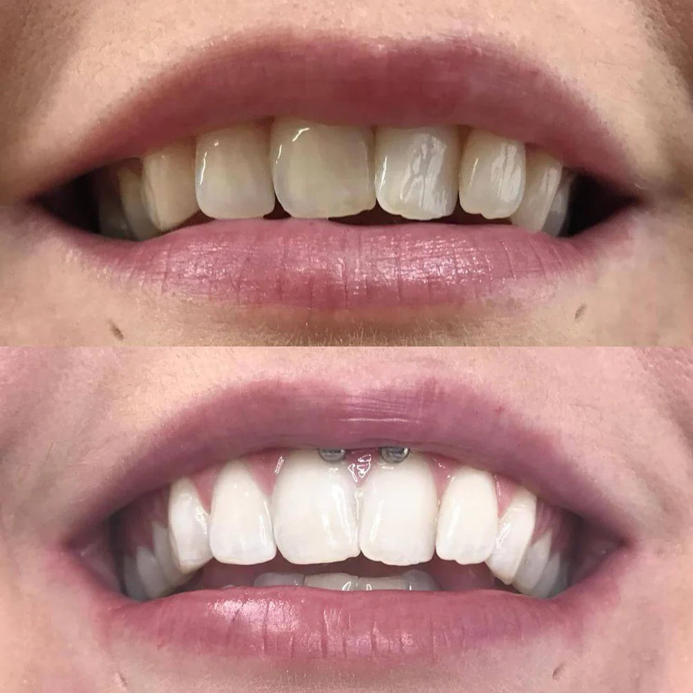 LumaShine™ — Unleash a Brilliant Smile That Commands Every Room