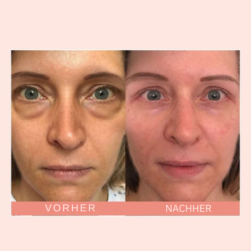 VioraLuxe™ Eye Renewal Stick — Reveal Youthful, Radiant Eyes That Captivate Instantly