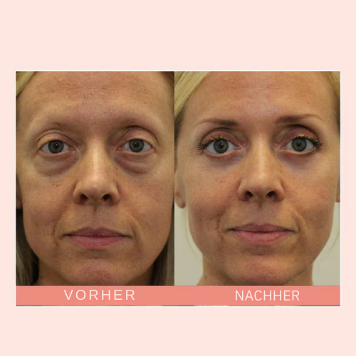 VioraLuxe™ Eye Renewal Stick — Reveal Youthful, Radiant Eyes That Captivate Instantly