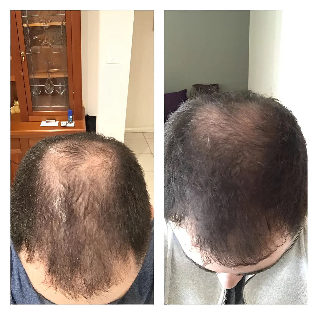 1+1 FREE | RiceGlow™ - Hair Loss Prevention (Final Day Discount)
