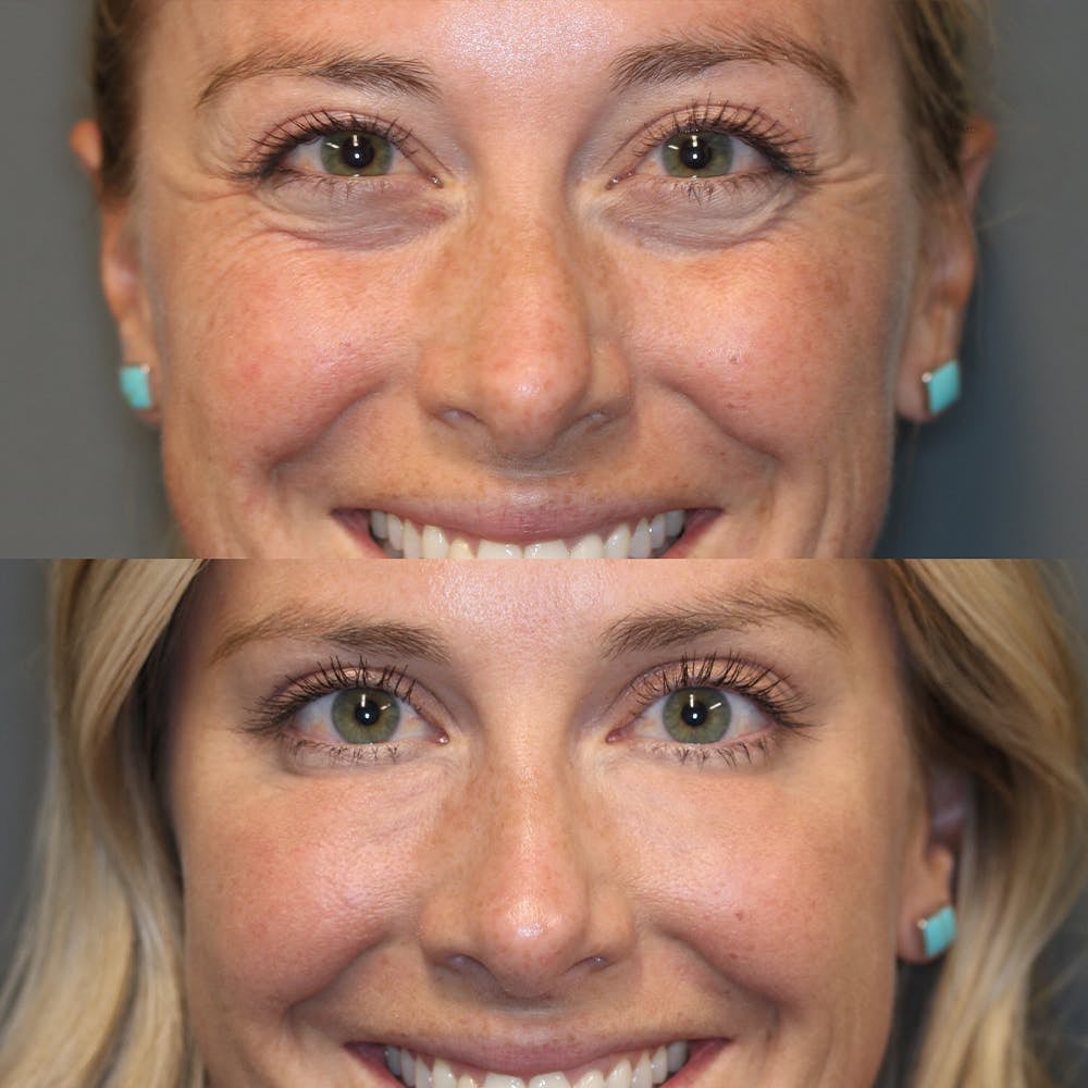 VioraLuxe™ Eye Renewal Stick — Reveal Youthful, Radiant Eyes That Captivate Instantly