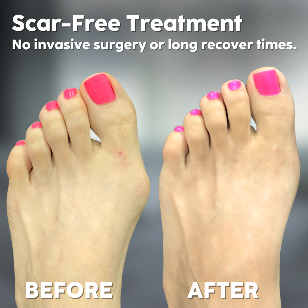 Alignix™ — Straighten Toes, End Bunion Pain Fast | 50% Off