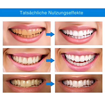 1+1 Free | OpalSmile™ – Achieve Bright White Teeth Quickly