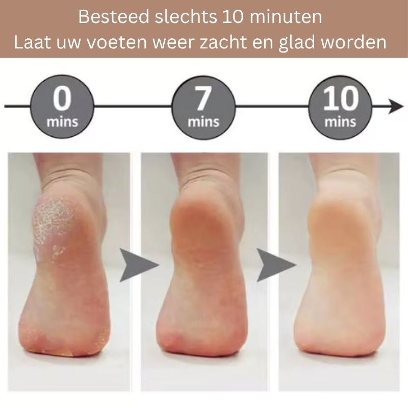 FootRenew™ - Eliminate Painful Calluses with Professional-Grade Strength and Comfort