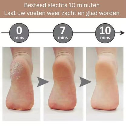 FootRenew™ - Eliminate Painful Calluses with Professional-Grade Strength and Comfort