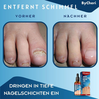 ToePerfect | Heal Nails Fast, Live Pain-Free | 50% Off