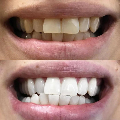 LumaShine™ — Unleash a Brilliant Smile That Commands Every Room