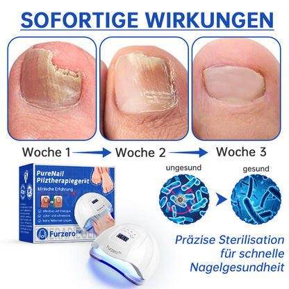 PureNail™ — Zap Nail Fungus Painlessly & Fast | 50% Off