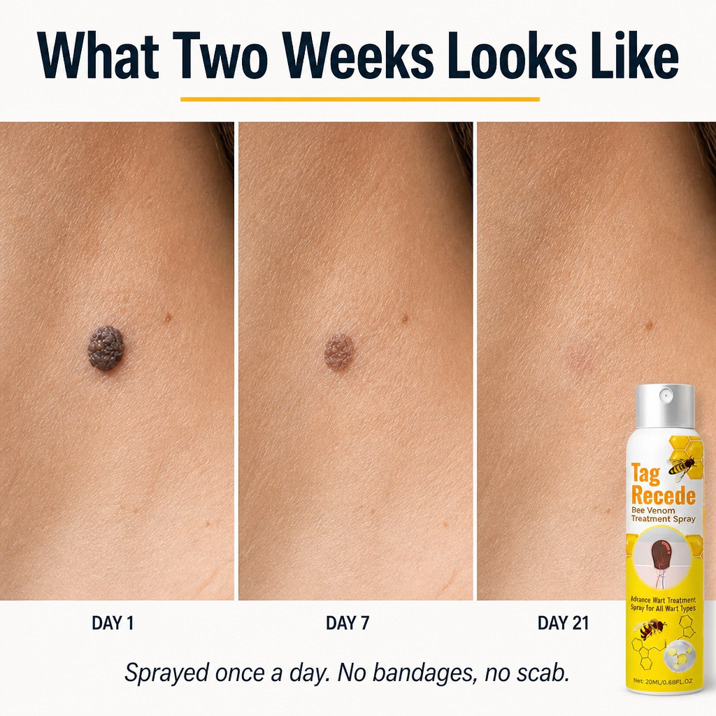 VenomaSilk™ — Effortlessly Spray Away Stubborn Warts Using Bee Venom and Salicylic Acid