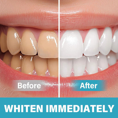 LumaBeam™ — Unleash a Radiant Smile That Turns Heads Without Pain or Sensitivity