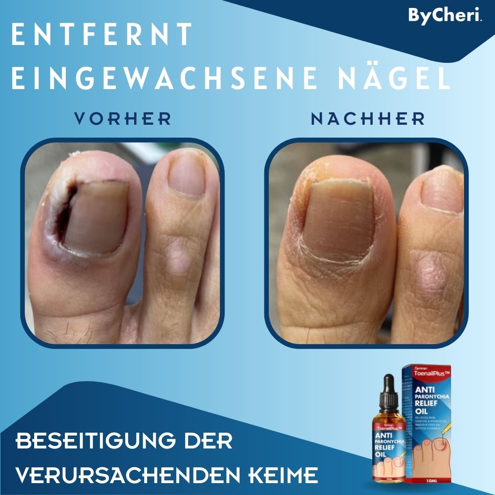 ToePerfect | Heal Nails Fast, Live Pain-Free | 50% Off