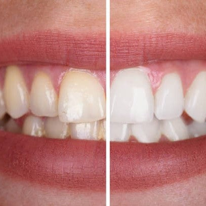 GlowCurve™ — Brighten Your Smile Fast Without the Pain or Hassle