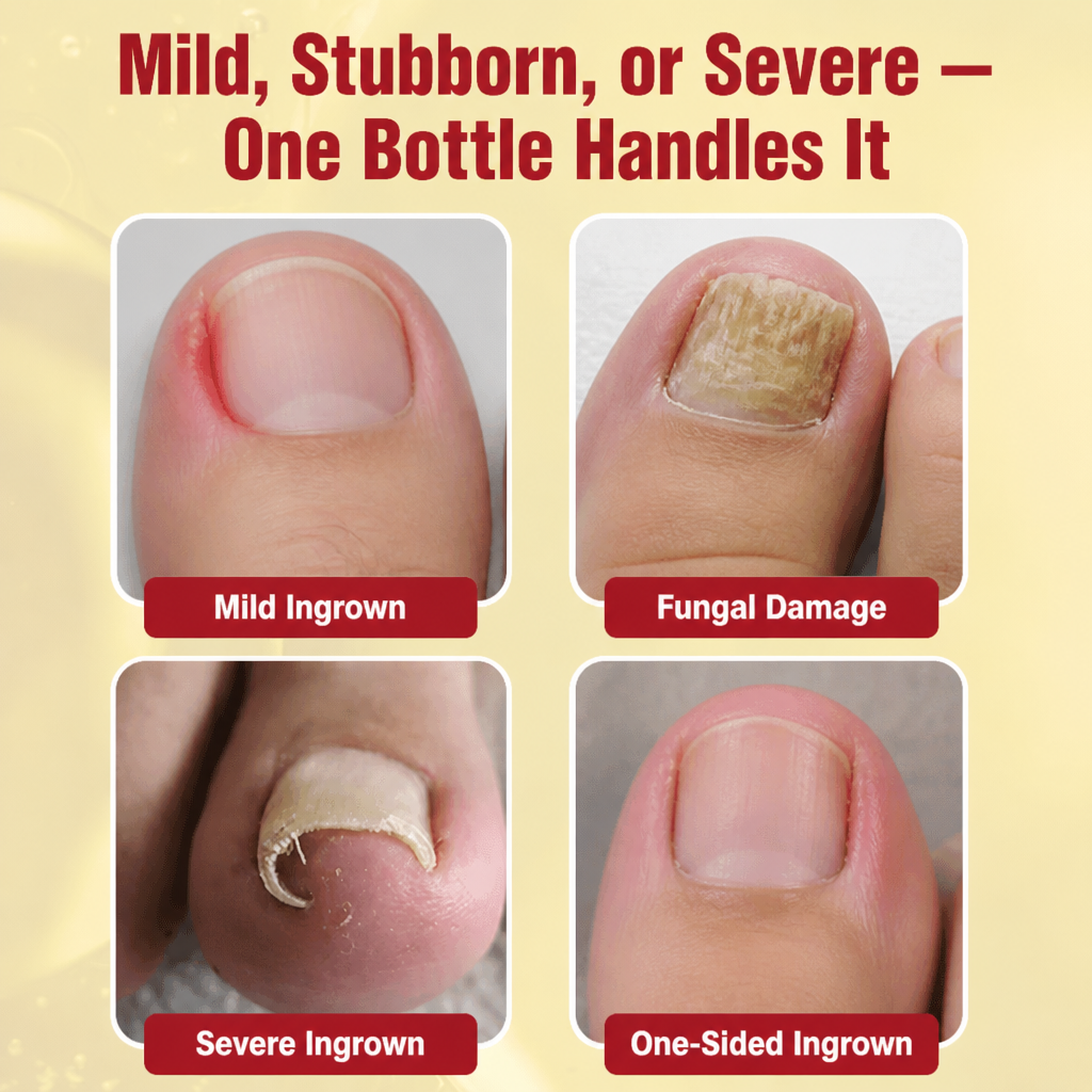NailFortify™ — Relieve Painful Ingrown Toenails and Fungal Harm from Home
