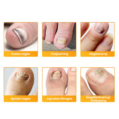ClearCure™ Nail Patches — Restore Gorgeous, Confident Nails Without the Embarrassment