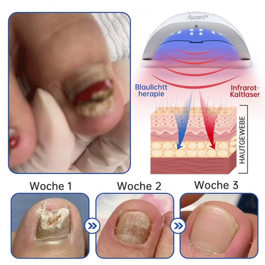 PureNail™ — Zap Nail Fungus Painlessly & Fast | 50% Off