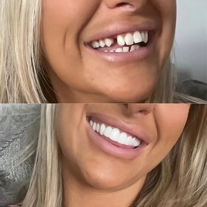 SmileLux™ — Instantly Own a Dazzling, Camera-Ready Smile Anywhere