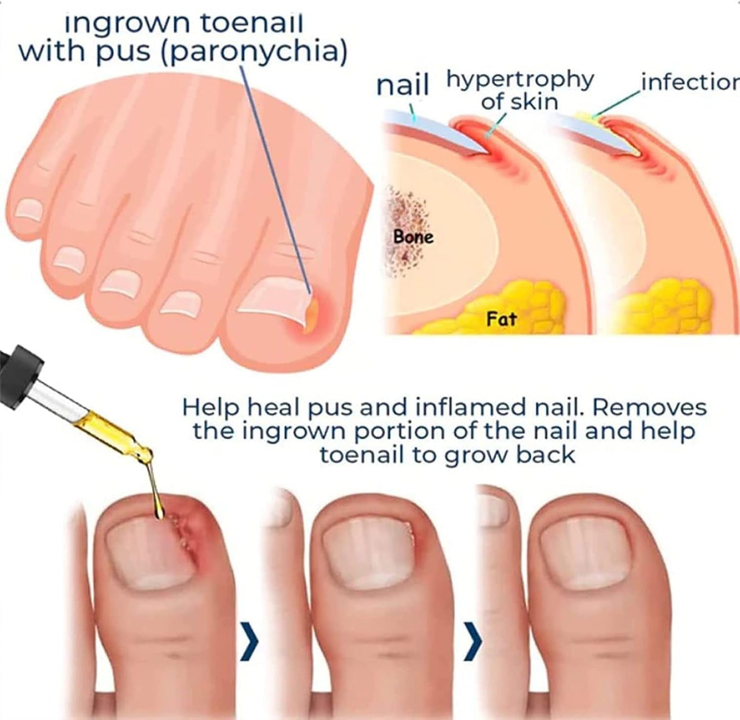 FungiFree| Treats toenails and fingernails