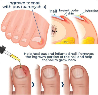 FungiFree| Treats toenails and fingernails