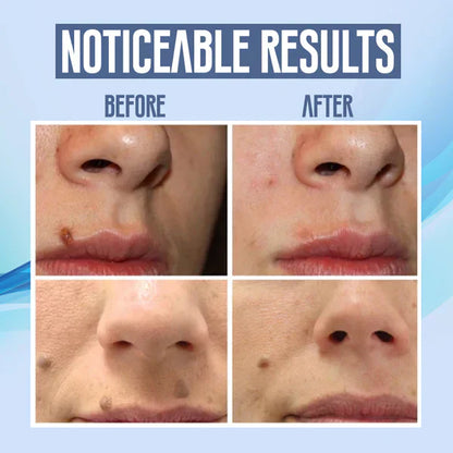 SpotClear | Zap Dark Spots Pain-Free & Fast | 50% Off