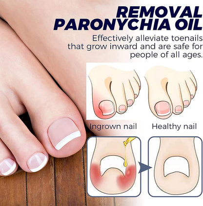 FungiFree| Treats toenails and fingernails
