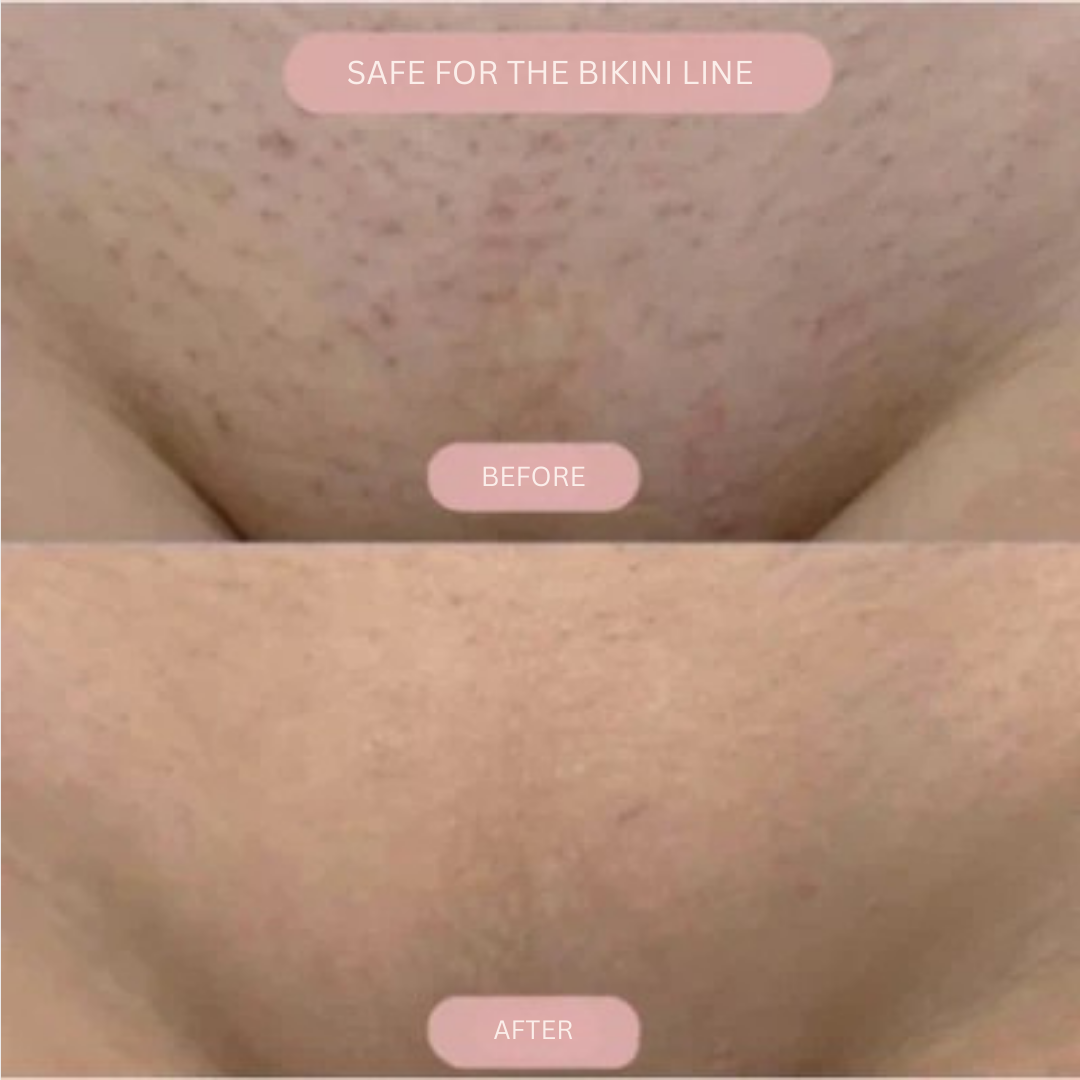 VeelaSmooth™ — Experience Blissful, Bump-Free Skin That Boosts Your Confidence Every Day