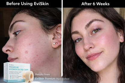 Clearlynx™ — Triple-Strength Power That Clears Pimples and Unleashes Your Radiant Confidence