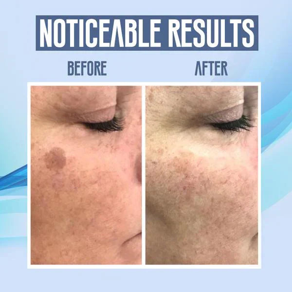 SpotClear | Zap Dark Spots Pain-Free & Fast | 50% Off