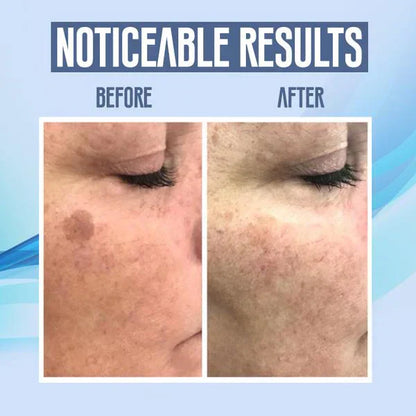 SpotClear | Zap Dark Spots Pain-Free & Fast | 50% Off