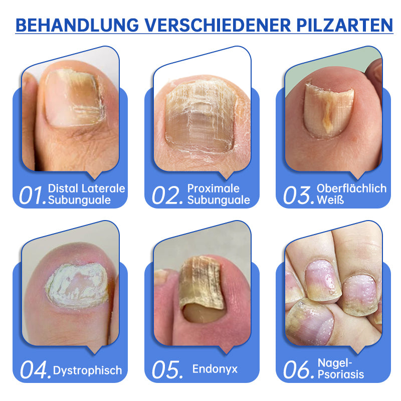 PureNail™ — Zap Nail Fungus Painlessly & Fast | 50% Off