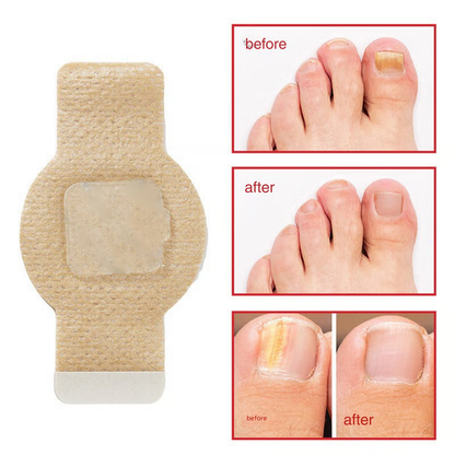 ClearCure™ Nail Patches — Restore Gorgeous, Confident Nails Without the Embarrassment