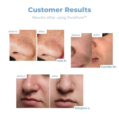 ClearPure™ — Unleash Silky, Blackhead-Free Skin That Radiates Confidence Every Day