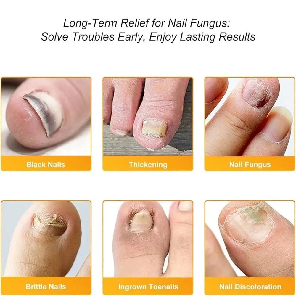 FungaGuard™ — Transform Your Nails Fast for Confidence That Shines Through