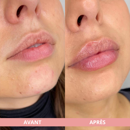 Arvilaro | Kit Ritual Lips - Thicker & Shiny lips in minutes