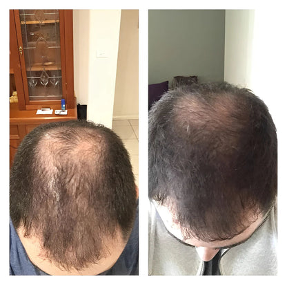 1+1 FREE | RiceGlow™ - Hair Loss Prevention (Final Day Discount)