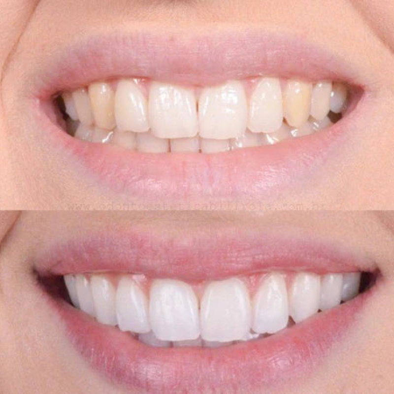 LuminaWhite™ — Instantly Unleash a Radiant Smile That Commands Every Room