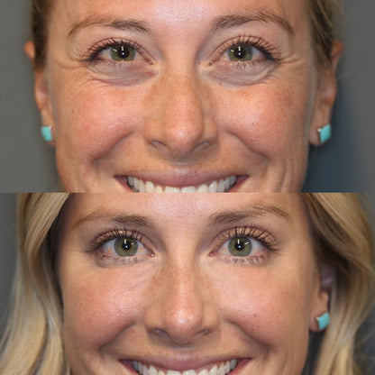 VioraLuxe™ Eye Renewal Stick — Reveal Youthful, Radiant Eyes That Captivate Instantly