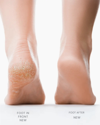 SootheStep™ — Reveal Silky, Confidence-Boosting Feet in Minutes