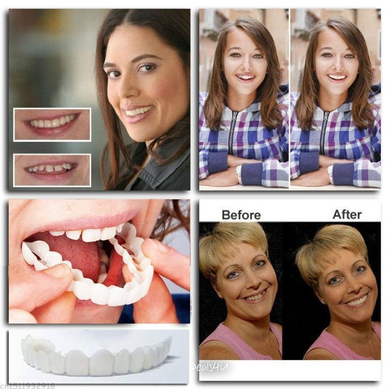 Dentures with Snap-On Design