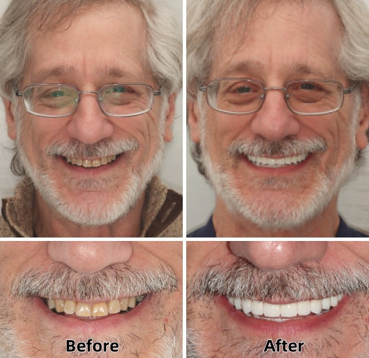 FlexDenta™ — Smile Freely Again with Dentures That Stay and Feel Real