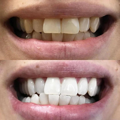LumaLux™ — Instantly Enhance Your Confidence with a Brighter, Radiant Smile