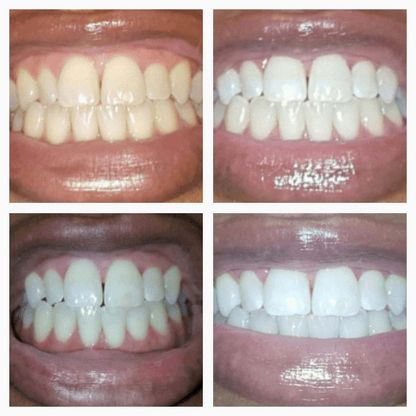BrilliaWhite™ Teeth Whitening Serum — Instantly Ignite Your Smile and Confidence Everywhere You Go